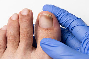 laser treatment for toenail fungus