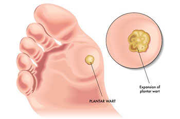 plantar wart